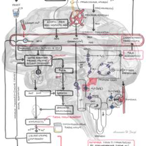 SIADH - Pathophysiology - Personal use