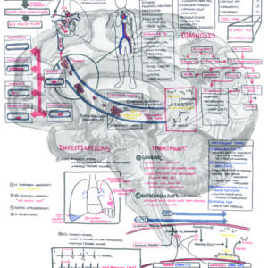 Pulmonary Embolism (DETAILED) - Personal use