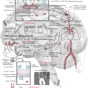 Primary Vasculitis (GCA and Takayasu arteritis) - Personal use