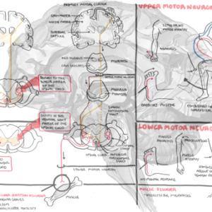 Upper and Lower Motor Lesions - Personal use