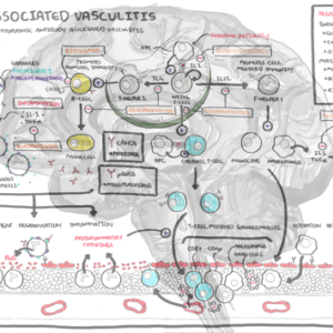 ANCA associated vasculitis - Personal use
