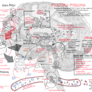 Multiple Myeloma - Personal use