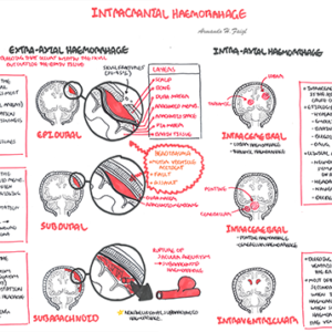 Intracranial Haemorrhage - Personal use