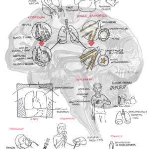 COPD - Overview - Personal use