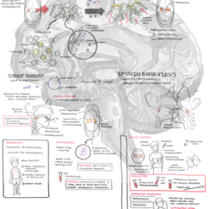 Acute tonsilitis - Personal use
