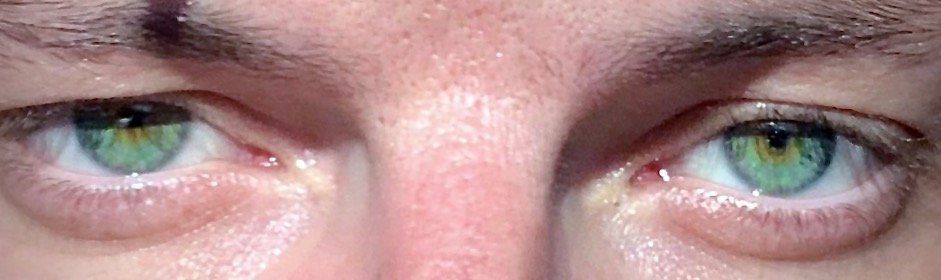 Bilateral pinpoint pupils and ptosis caused by opioid toxicity