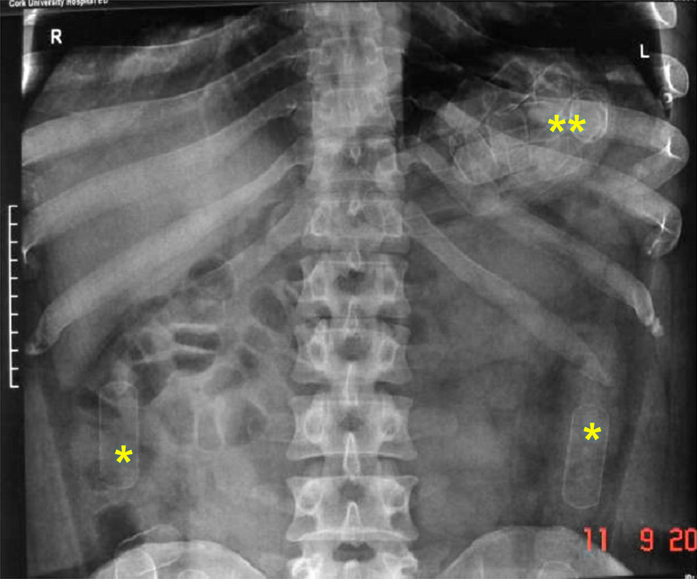 Abdominal radiograph showing multiple ingested drug packets in the stomach and intestines