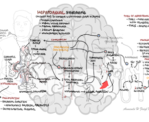 Hepatorenal Syndrome - Personal use