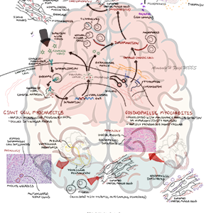 Myocarditis - Personal use
