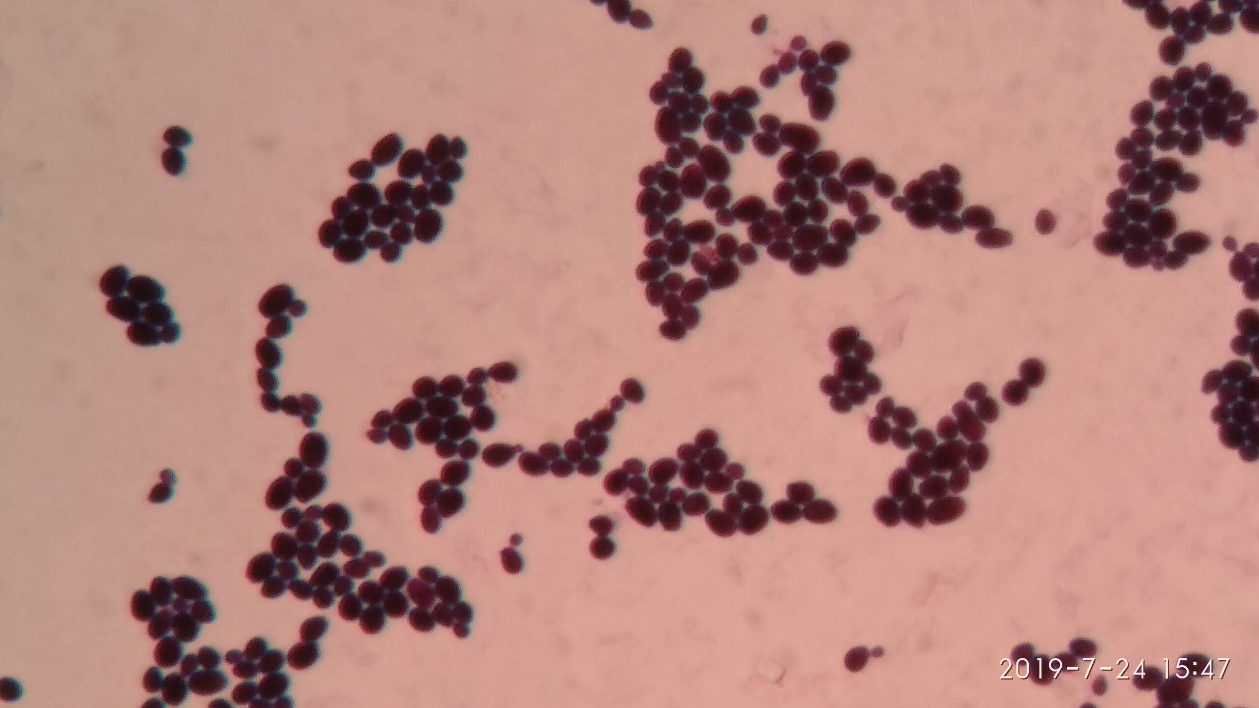 Gram-stained microscopy showing multiple purple oval Candida albicans yeast cells.