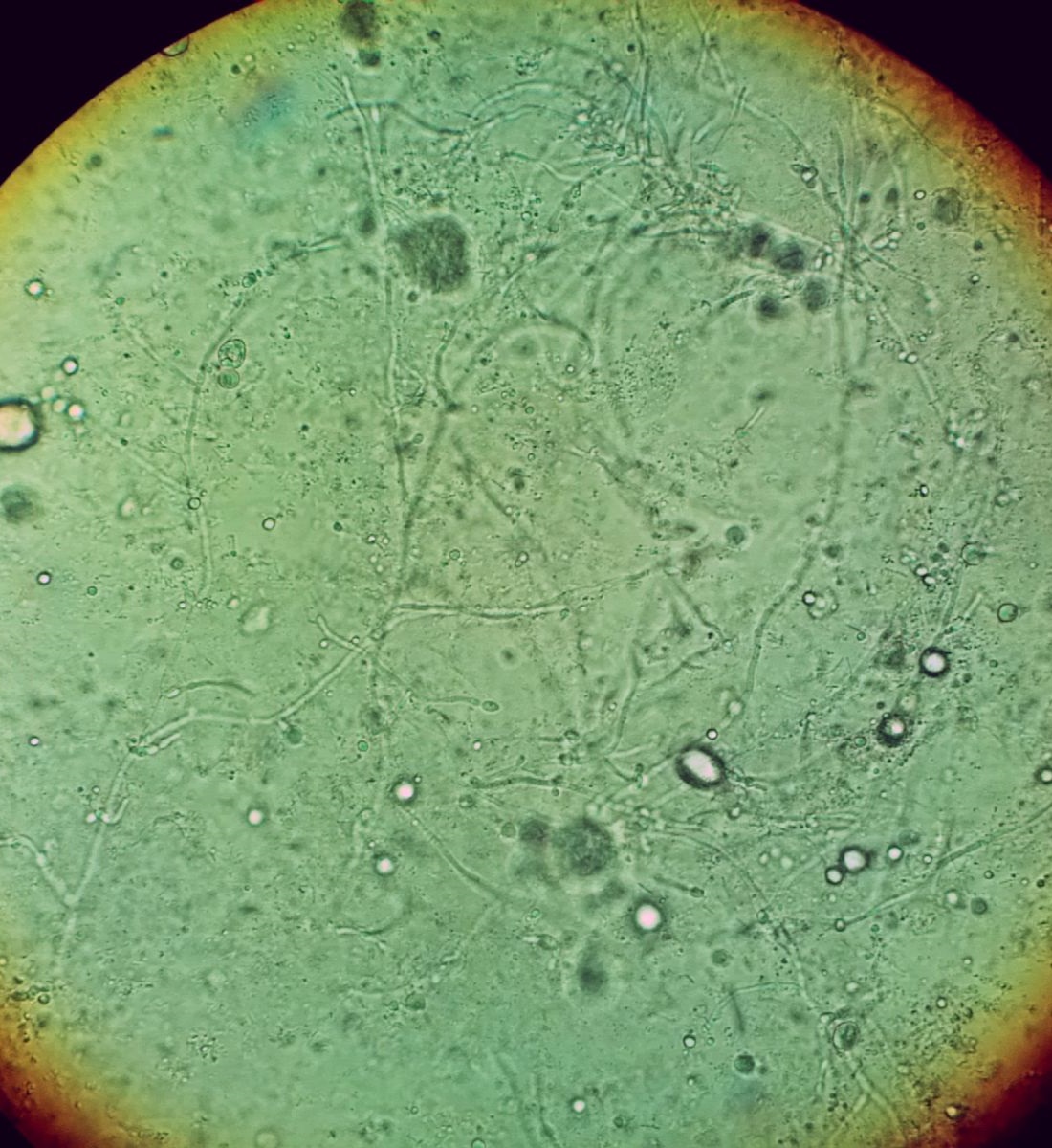 Vaginal potassium-hydroxide wet mount showing branching Candida pseudohyphae among circular preparation artefacts.
