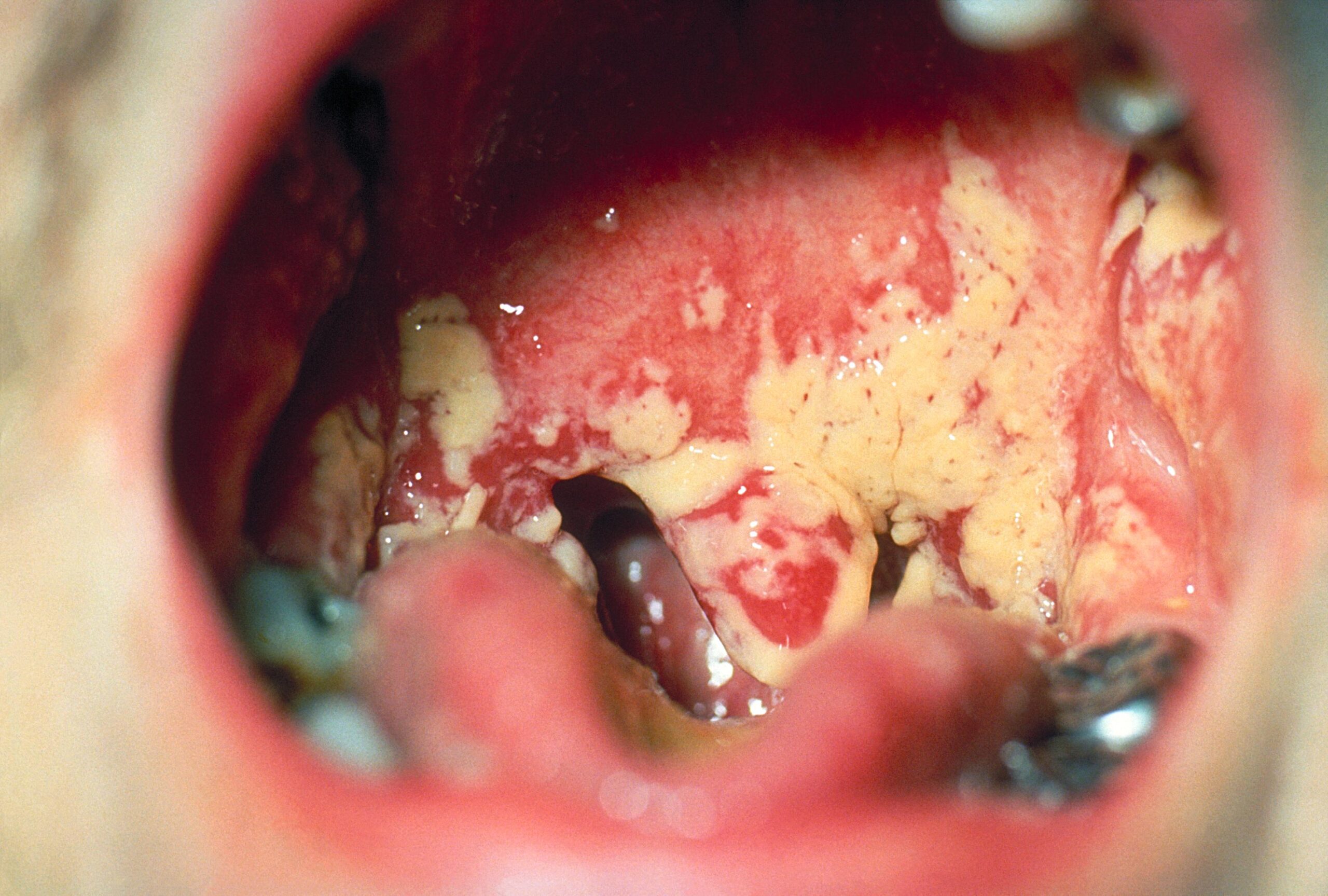 Oral cavity with extensive adherent white plaques caused by oral candidiasis.