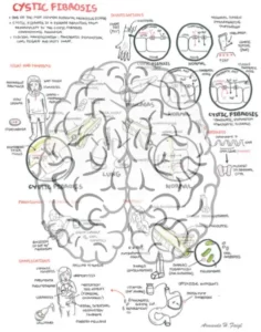Idiopathic Pulmonary Fibrosis infographic thumbnail by armando hasudungan