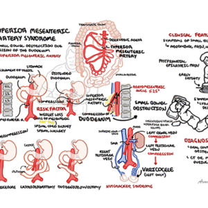 Superior mesenteric artery syndrome (SMA Syndrome) and Nutcracker Syndrome
