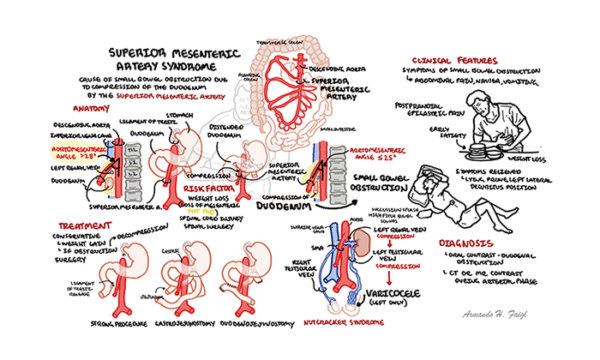Superior mesenteric artery syndrome (SMA Syndrome) and Nutcracker Syndrome
