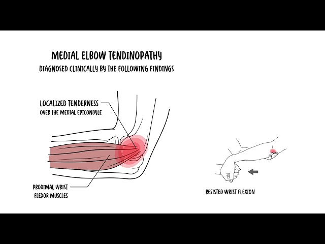 Thumbnail for YouTube medical video: Medial Elbow Tendinopathy (Golfer’s Elbow) Explained
