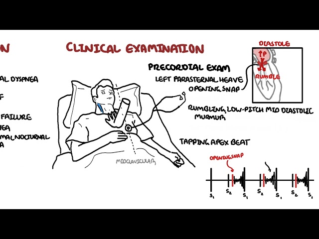 Thumbnail for YouTube medical video: Mitral Stenosis - causes, pathophysiology and treatment