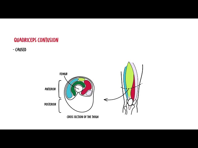 Thumbnail for YouTube medical video: Quadriceps Muscle - quadriceps mujscle injury, strain, quadriceps contusion