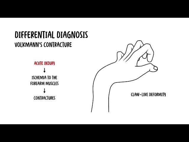 Thumbnail for YouTube medical video: Dupuytren's Contracture