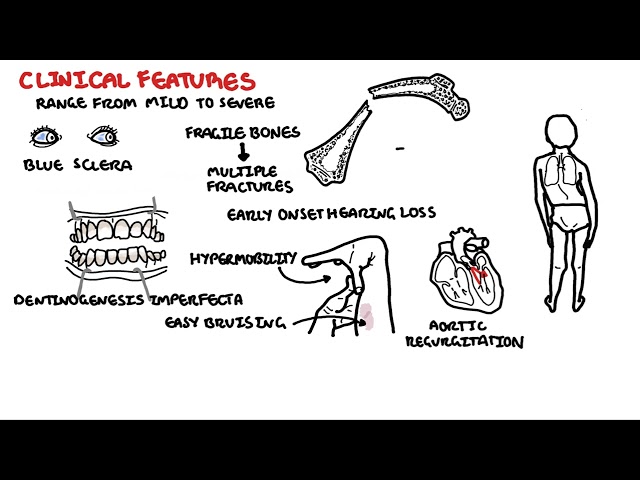 Thumbnail for YouTube medical video: Osteogenesis Imperfecta