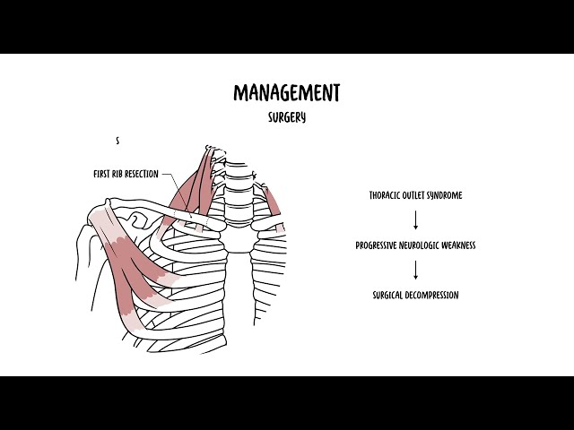 Thumbnail for YouTube medical video: Thoracic Outlet Obstruction Explained