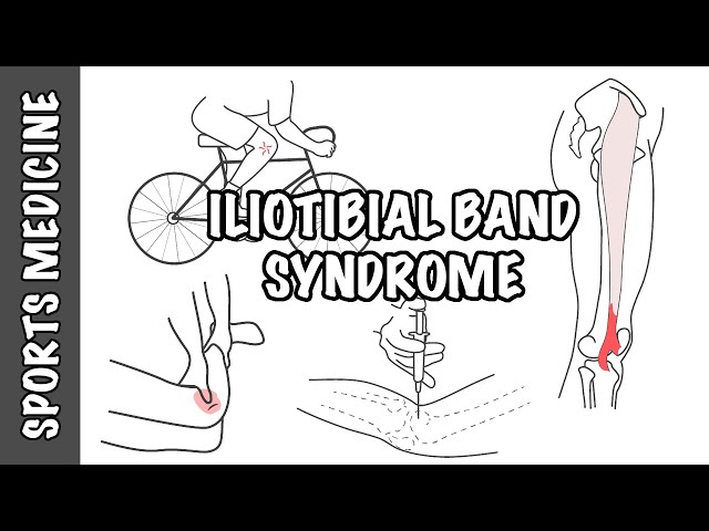 Thumbnail for YouTube medical video: Iliotibial Band Syndrome (ITBS) - Overview