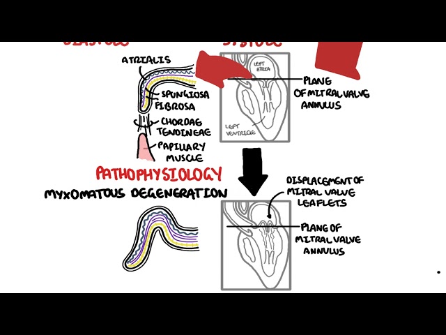 Thumbnail for YouTube medical video: Mitral Valve Prolapse