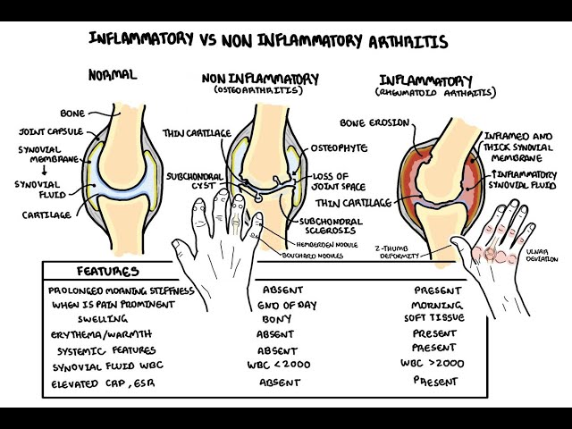 Thumbnail for YouTube medical video: Inflammatory vs non-inflammatory arthritis