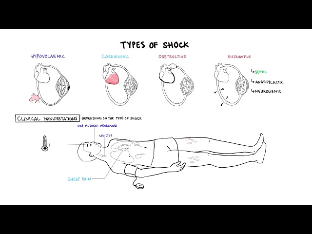 Thumbnail for YouTube medical video: Approach to Shock - types, hypovolemic, cardiogenic, distributive, anaphylaxis…