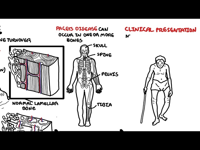 Thumbnail for YouTube medical video: Paget's Disease of the bone