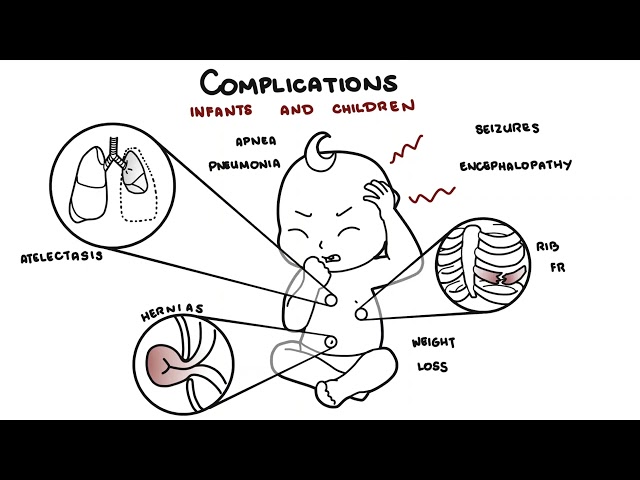 Thumbnail for YouTube medical video: What is Pertussis and whooping cough? - Bordetella pertussis symptoms…