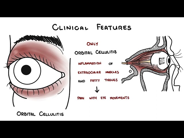 Thumbnail for YouTube medical video: Orbital VS Preorbital Cellulitis