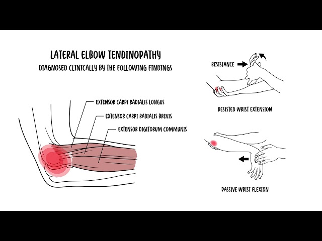 Thumbnail for YouTube medical video: Tennis elbow - lateral elbow tendinopathy (lateral epicondylitis)