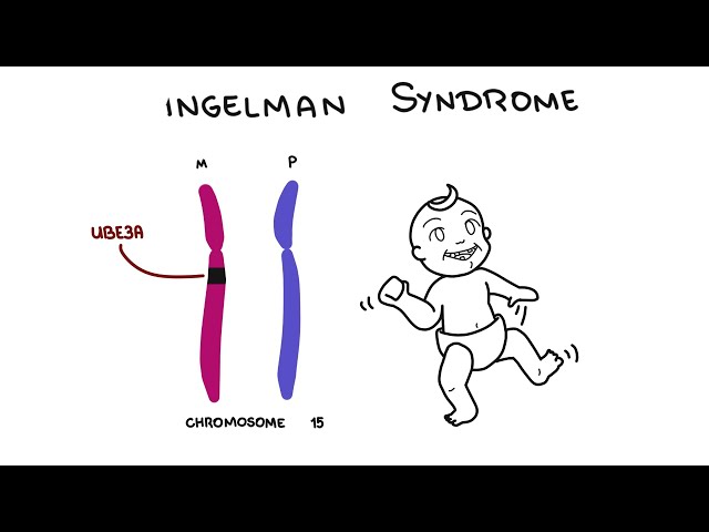 Thumbnail for YouTube medical video: Angelman Syndrome
