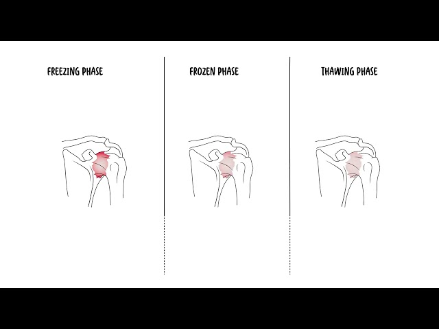 Thumbnail for YouTube medical video: Understanding Frozen Shoulder (Adhesive capsulitis)