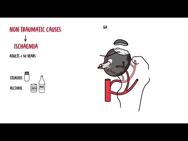 Thumbnail for YouTube medical video: Osteonecrosis of the Hip (femoral head) - Avascular Necrosis