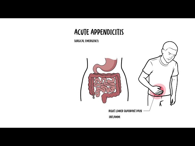 Thumbnail for YouTube medical video: What Is Appendicitis? Symptoms, Causes & Treatment Explained