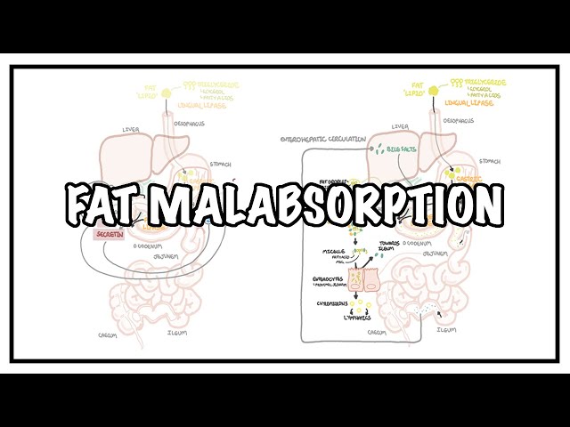 Thumbnail for YouTube medical video: Approach to Fat malabsorption - signs and symptoms and causes