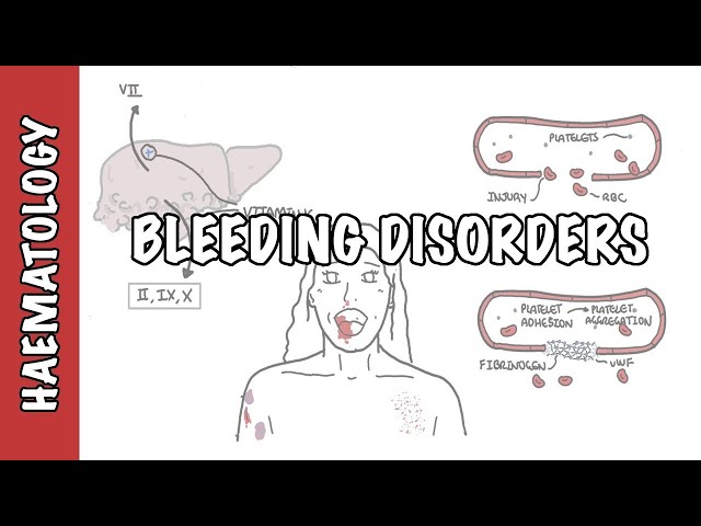 Thumbnail for YouTube medical video: Approach to bleeding disorders - causes, pathophysiology and investigations