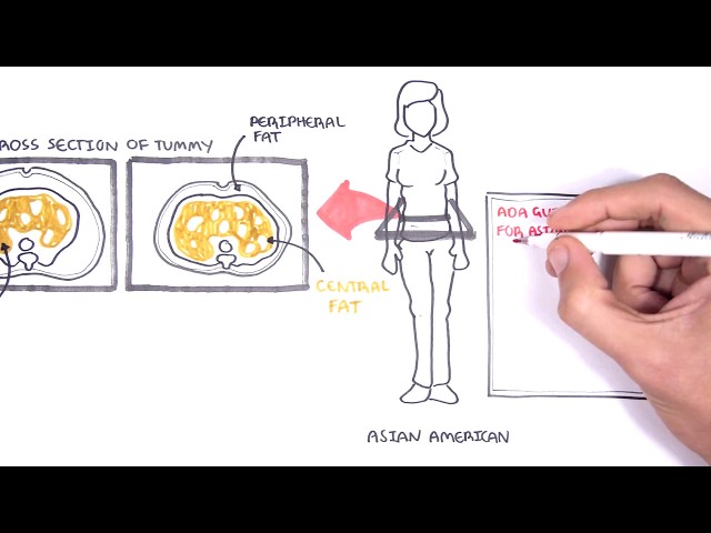Thumbnail for YouTube medical video: ADA New Diabetes Screening Guidelines — Others