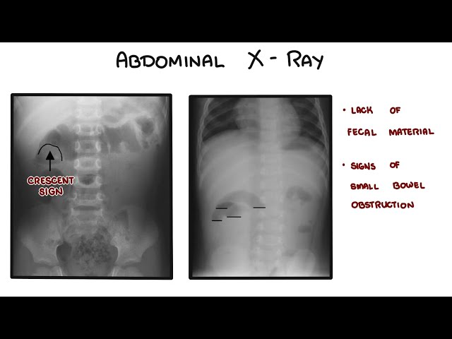 Thumbnail for YouTube medical video: Intussusception