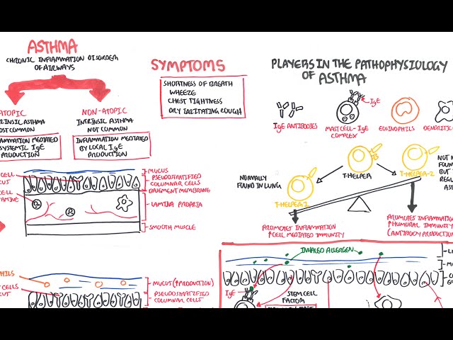Thumbnail for YouTube medical video: Asthma Pathophysiology — Pathophysiology