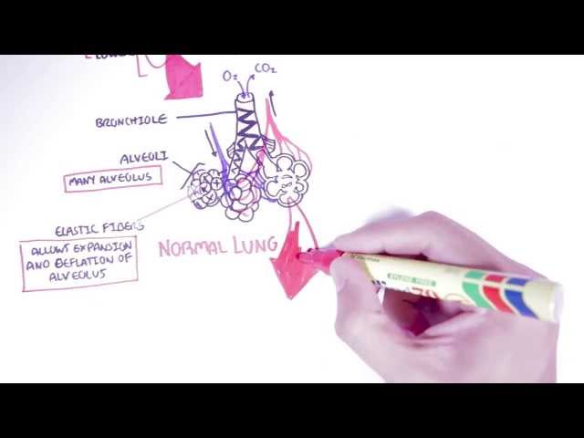 Thumbnail for YouTube medical video: Emphysema - Introduction, Types, Symptoms, Diagnosis — Pathophysiology