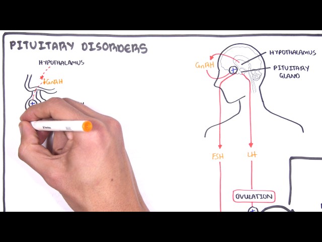 Thumbnail for YouTube medical video: Gynaecology - Infertility in Women (causes and pathophysiology) — Others