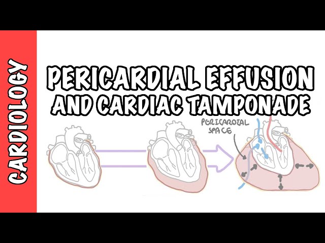 Thumbnail for YouTube medical video: Cardiac Tamponade - pericardial effusion, causes, pathophysiology, investigations…