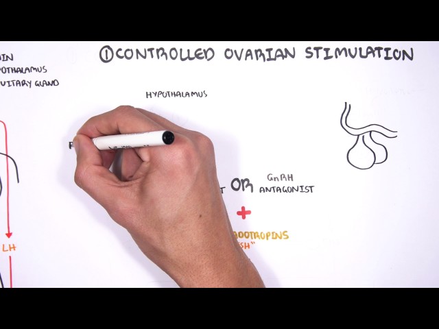 Thumbnail for YouTube medical video: In Vitro Fertilization (IVF) - Overview — Others