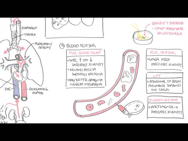 Thumbnail for YouTube medical video: PART II - Pneumonia (Transmission, Causative Agents, Investigations, Management) —…