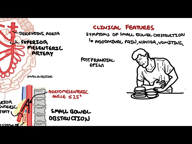 Thumbnail for YouTube medical video: Superior mesenteric artery syndrome (SMA Syndrome) and Nutcracker Syndrome —…