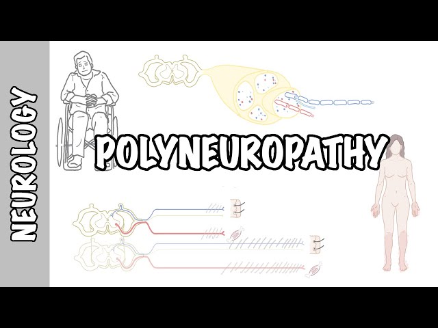 Thumbnail for YouTube medical video: Approach to Polyneuropathy - causes, pathophysiology, investigations