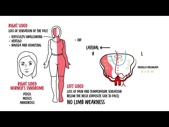 Thumbnail for YouTube medical video: Medulla Oblongata Syndromes - Medial and Lateral Medullary Syndrome, Medullary…